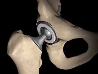 hip replacement