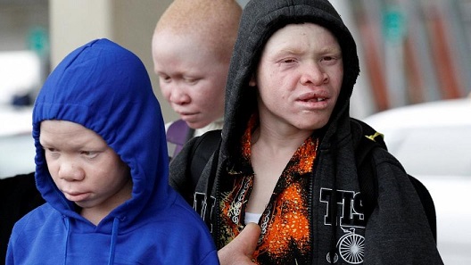 Tanzanian albinos